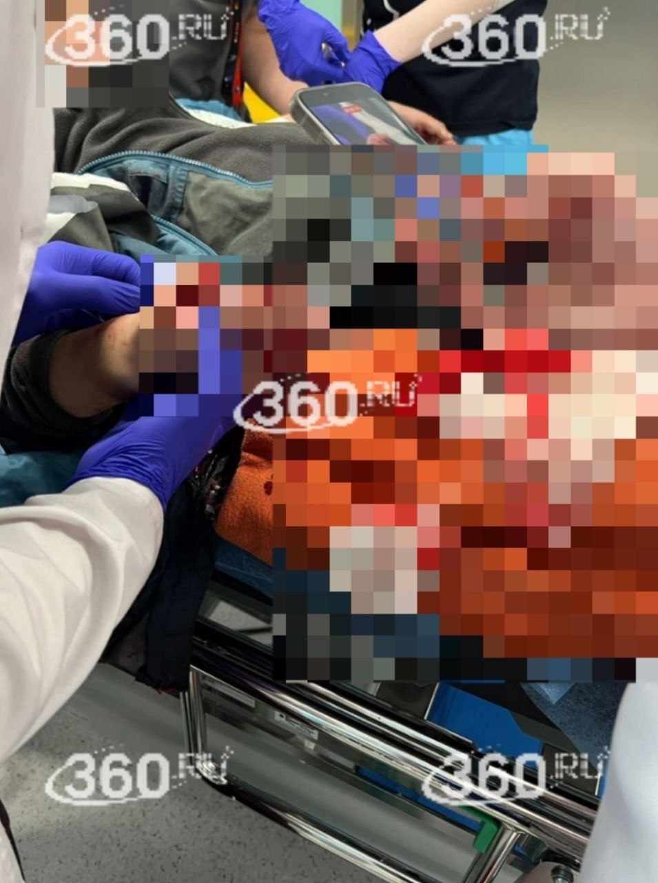 Мальчишке, который потерял кисть руки из-за детонации СВУ в купюрах, изготовили индивидуальный протез Мальчишке, который потерял кисть руки из-за детонации СВУ в купюрах, изготовили индивидуальный протез