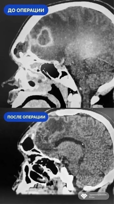 Лечил насморк, попал к хирургам с отеком мозга: сургутянин перестал дышать, и только после этого обратился к врачу Лечил насморк, попал к хирургам с отеком мозга: сургутянин перестал дышать, и только после этого обратился к врачу